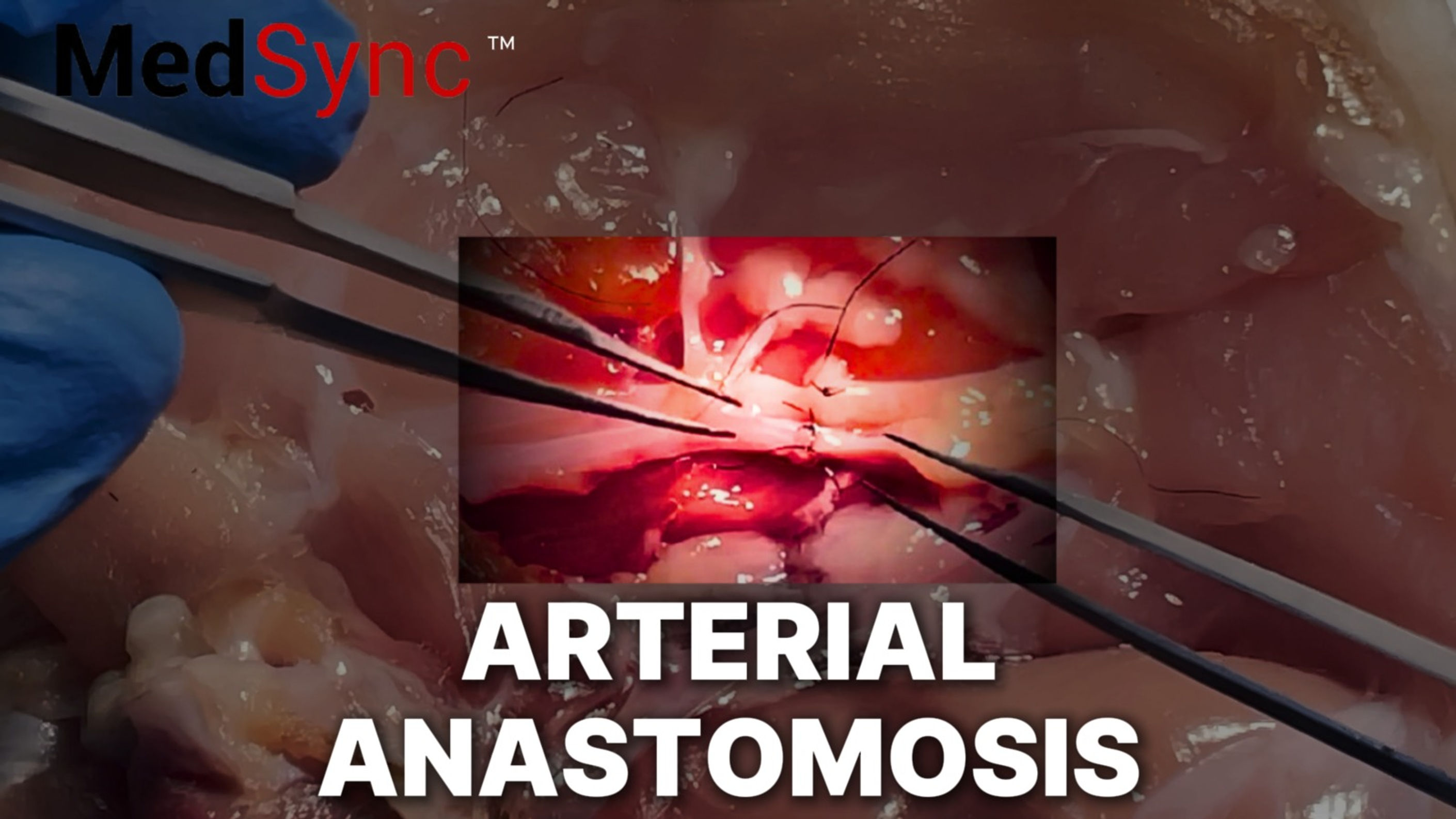 Arterial Anastomosis (Preview)